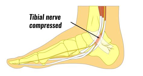 tibial nerve compression test|tibial nerve impingement symptoms.